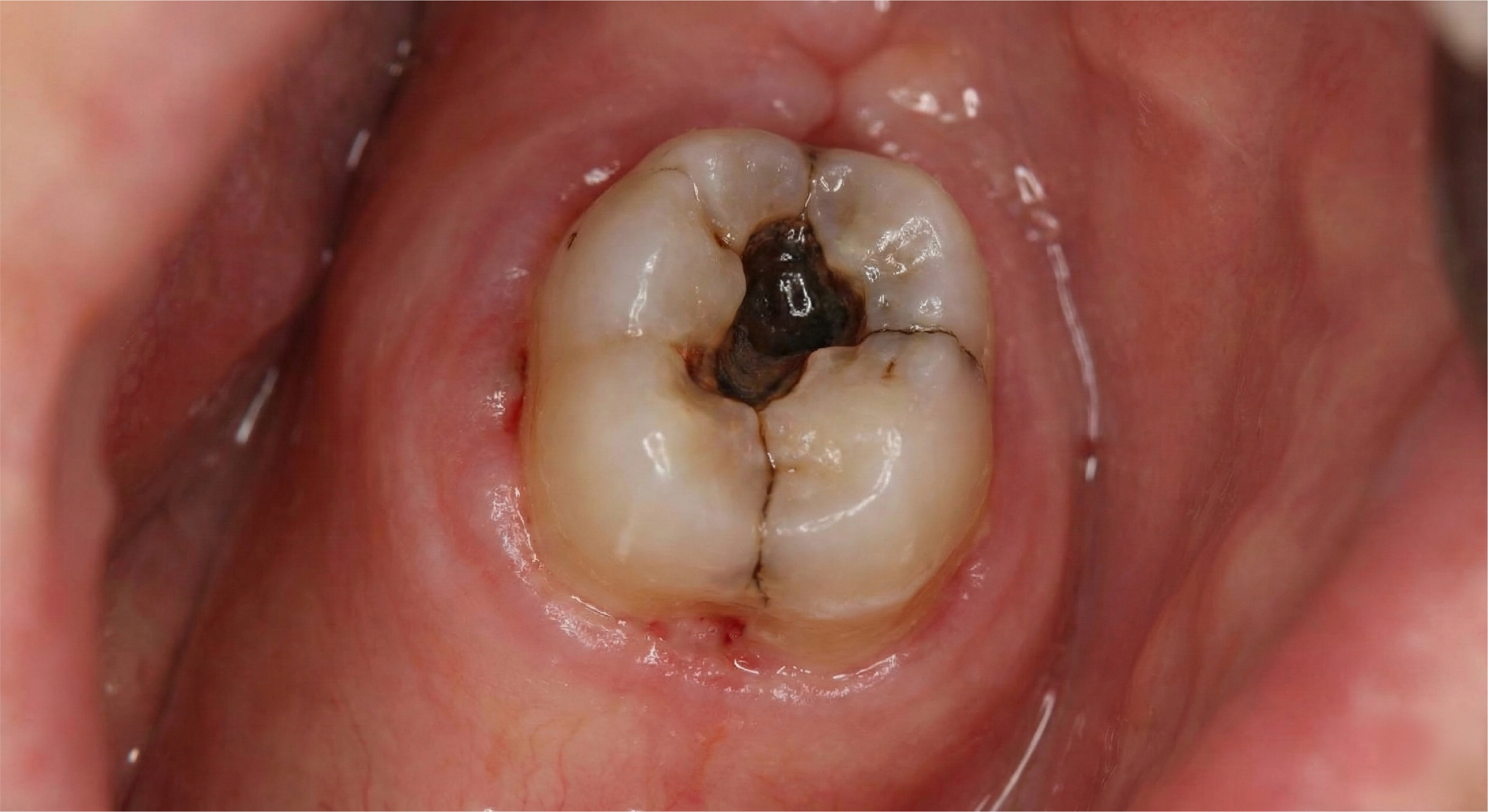 Before — PFM Crowns